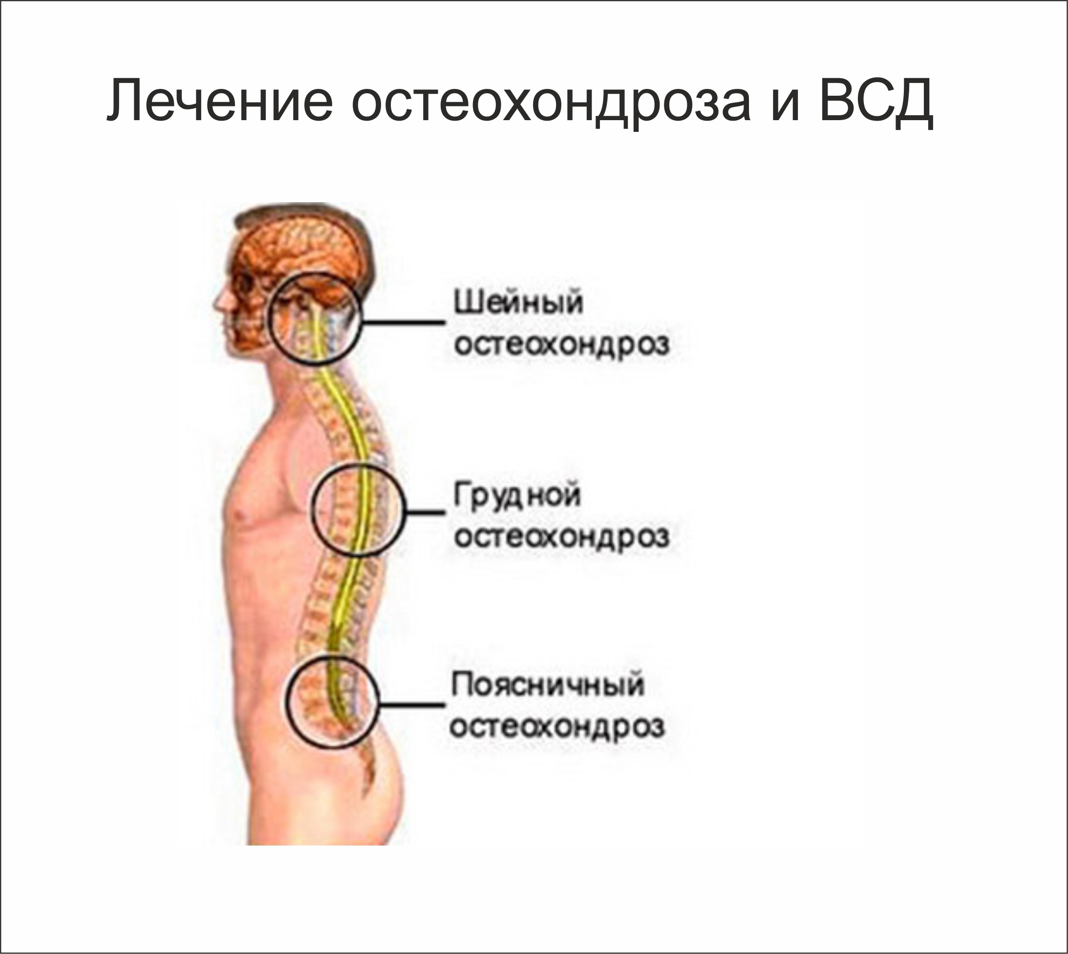 Всд и шейный остеохондроз как лечить Всд и шейный остеохондроз как лечить